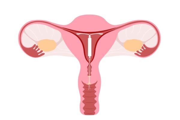Pregnancy Signs to Watch For With an IUD