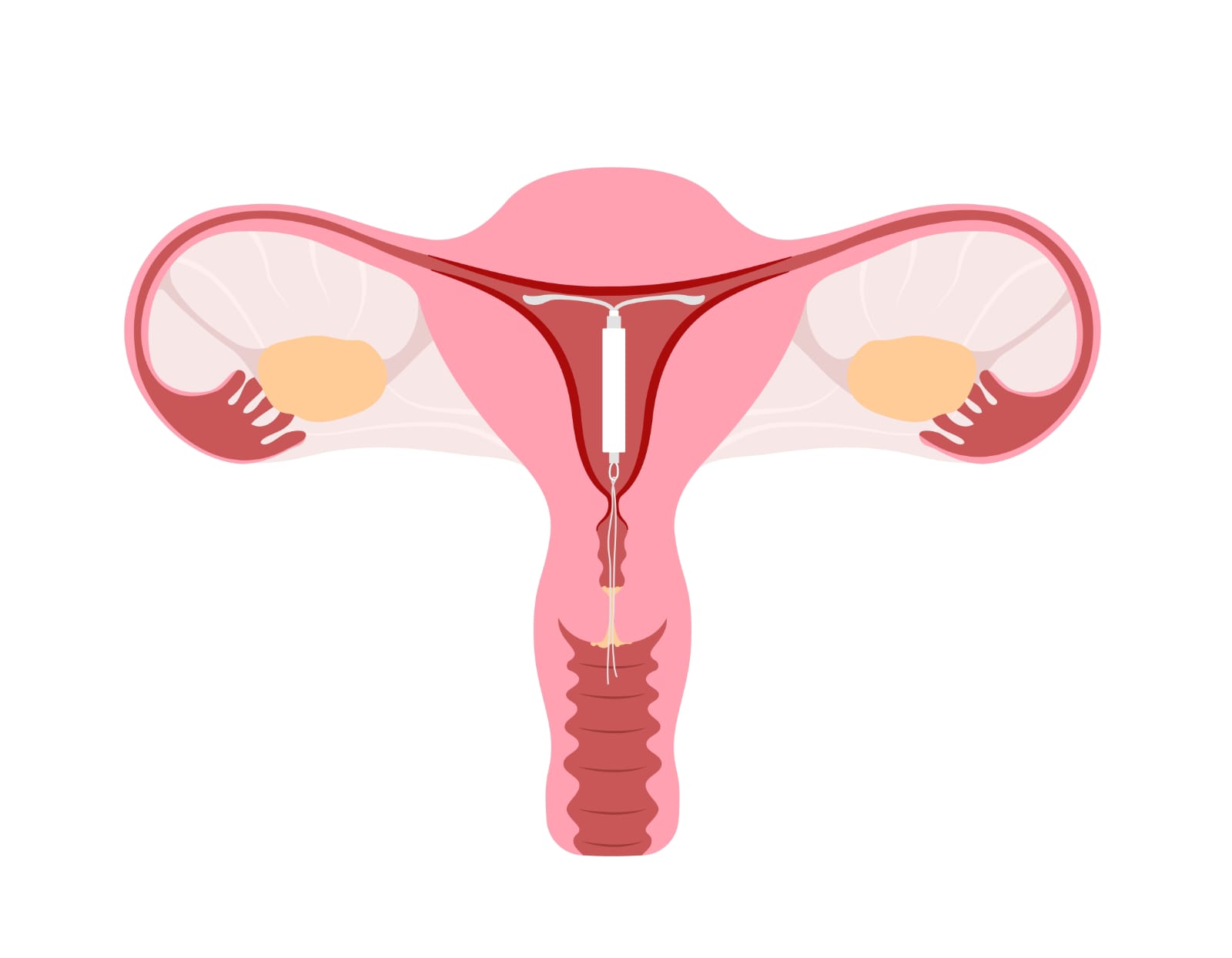 Pregnancy Signs to Watch For With an IUD