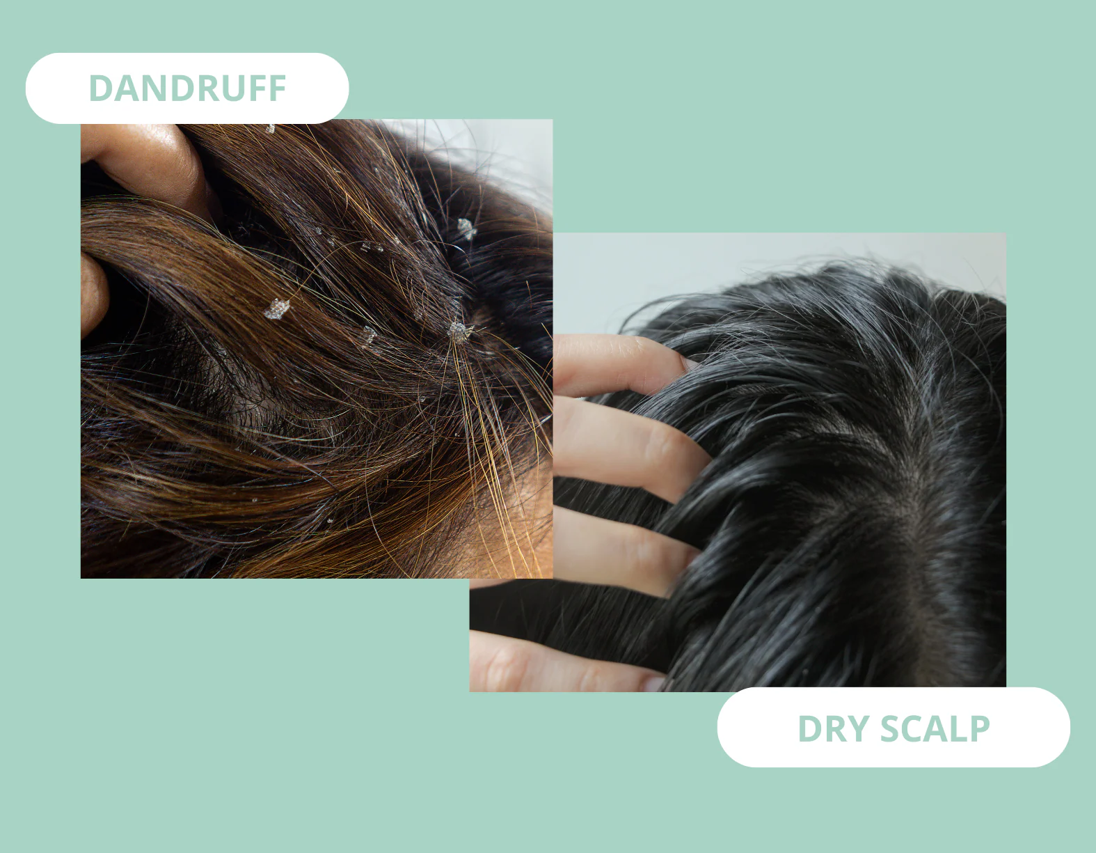 Dandruff vs Dry Scalp: Key Signs to Know
