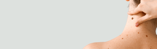 Skin Cancer Shock: Woman’s Gut Instinct Saves Her Life