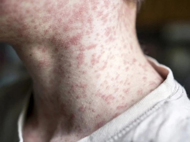 Canada Faces Measles Comeback After Losing Elimination Status