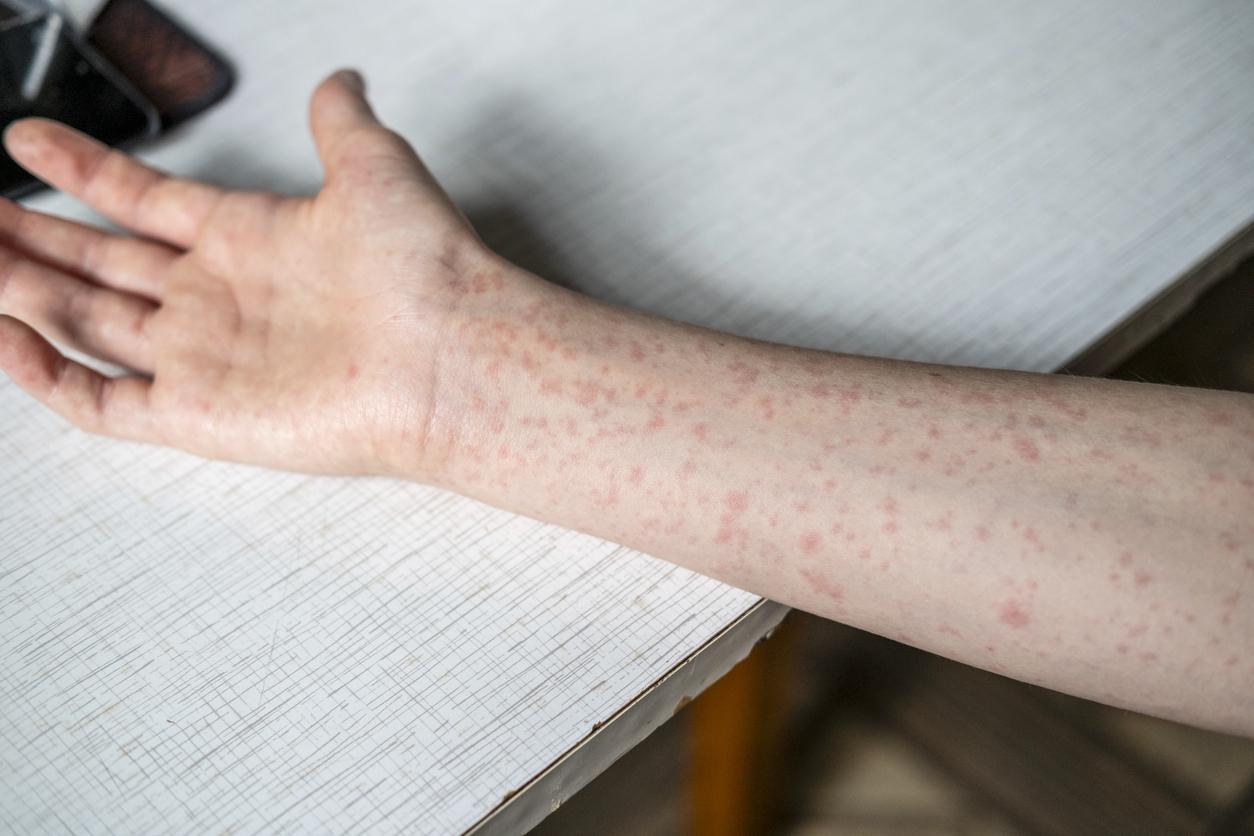 U.S. Measles Cases Cross 2,000 in 2025